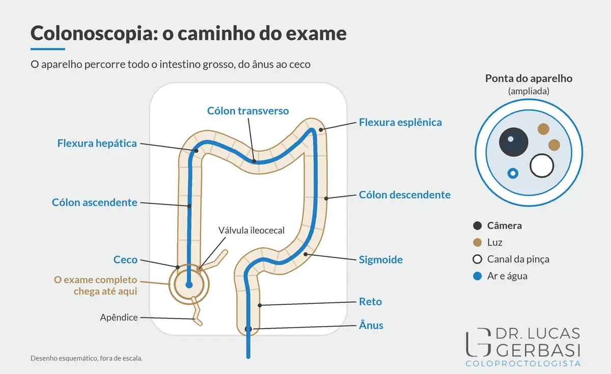 Esquema da colonoscopia: o aparelho percorre todo o intestino grosso, do ânus ao ceco, com a ponta ampliada e o nome de cada parte.