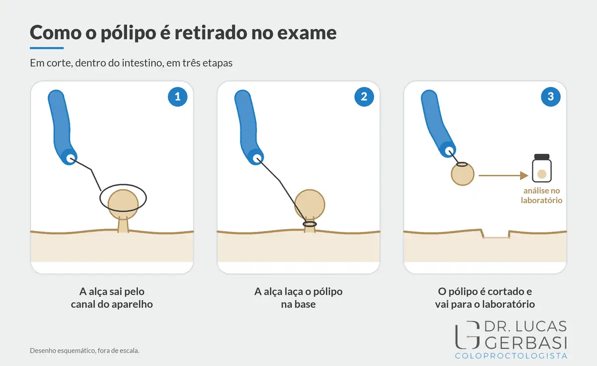 Como o pólipo é retirado na colonoscopia: a alça laça a base do pólipo, corta e o recolhe para análise no laboratório, em três quadros.